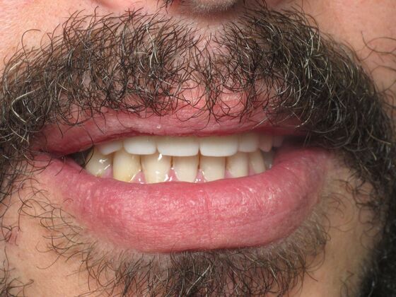 Teeth in a Day: Broken Teeth Solved - After