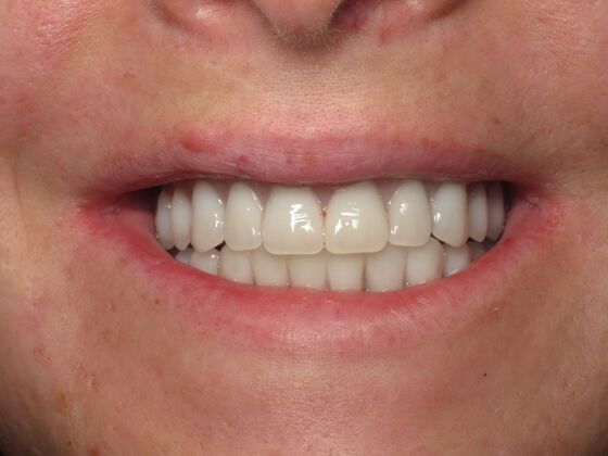 Teeth in a Day: Words Do Not Due Justice - After