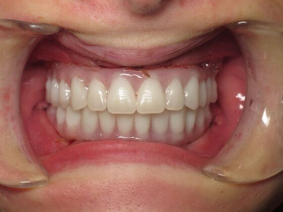 Teeth in a Day: Words Do Not Due Justice - Before