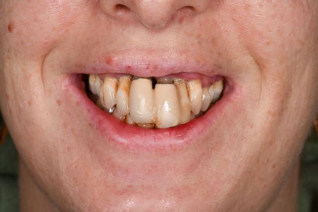 Teeth in a Day: Words Do Not Due Justice - Before