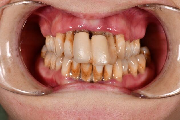 Teeth in a Day: Words Do Not Due Justice - After