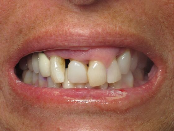 Teeth in a Day: Beautiful Transformation - Before