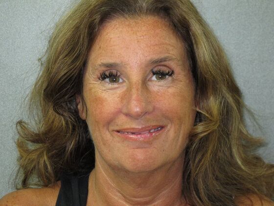 Teeth in a Day: Beautiful Transformation - Before