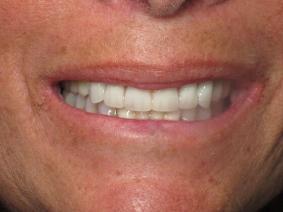 Teeth in a Day: Beautiful Transformation - After