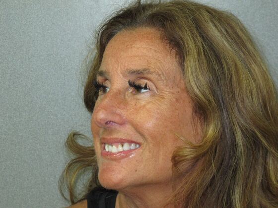 Teeth in a Day: Beautiful Transformation - Before