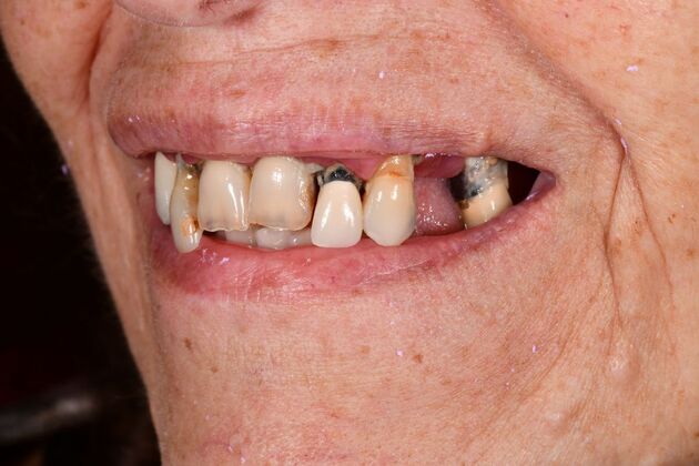 Teeth in a Day: Hard to Believe it was Possible - After