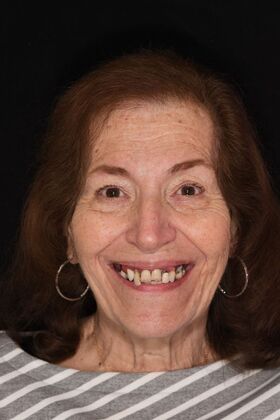 Teeth in a Day: Hard to Believe it was Possible - Before