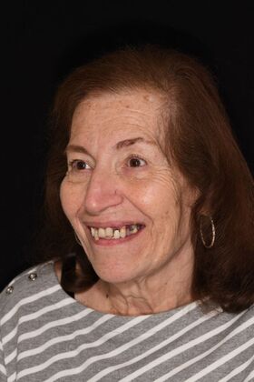 Teeth in a Day: Hard to Believe it was Possible - Before