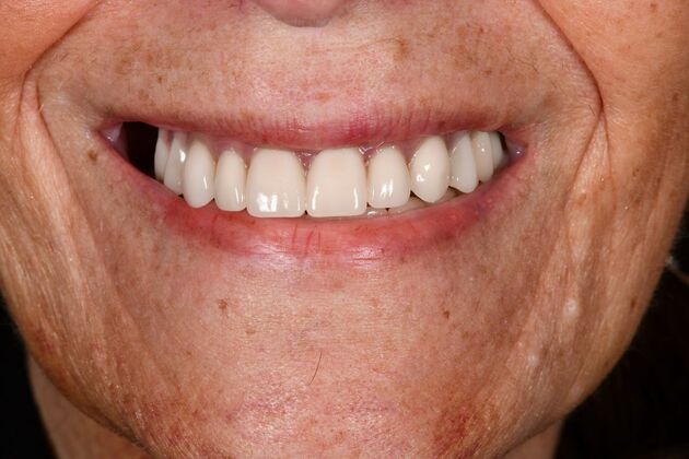 Teeth in a Day: Hard to Believe it was Possible - After