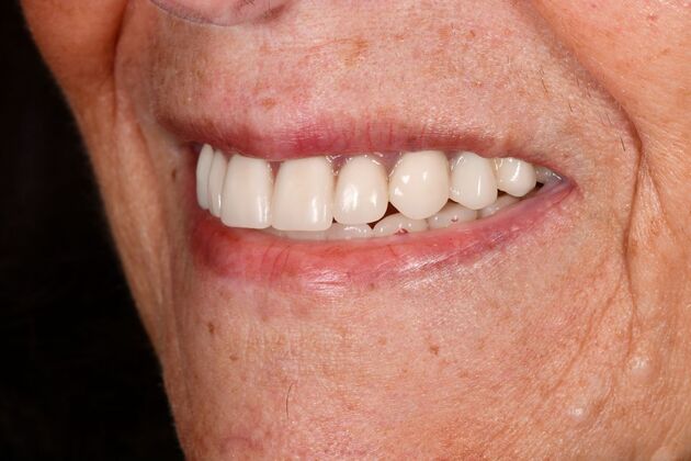 Teeth in a Day: Hard to Believe it was Possible - Before