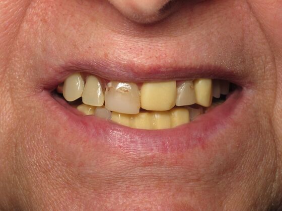 Teeth in a Day: Kathleen can start living again - Before