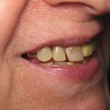 Teeth in a Day: Kathleen can start living again - Before