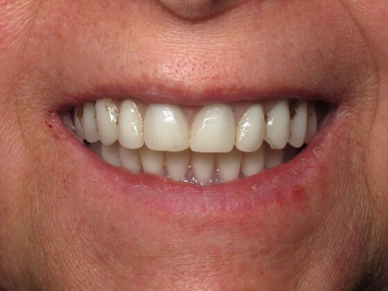 Teeth in a Day: Kathleen can start living again - After