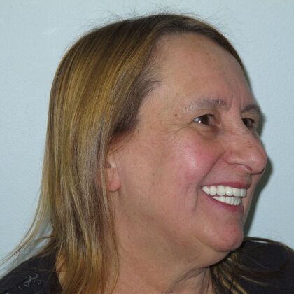 Teeth in a Day: Kathleen can start living again - After