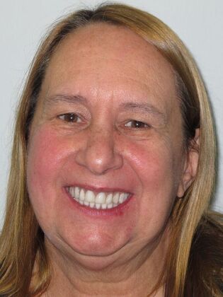 Teeth in a Day: Kathleen can start living again - Before