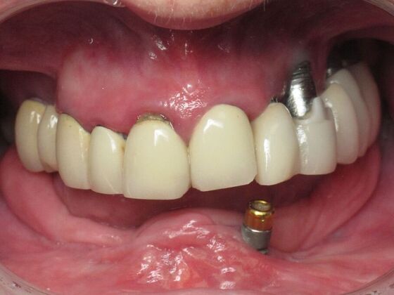 Teeth in a Day: Zest For Life Restored with Smile - Before