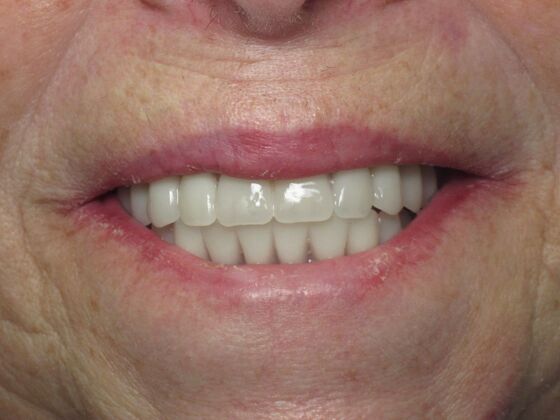 Teeth in a Day: Zest For Life Restored with Smile - After