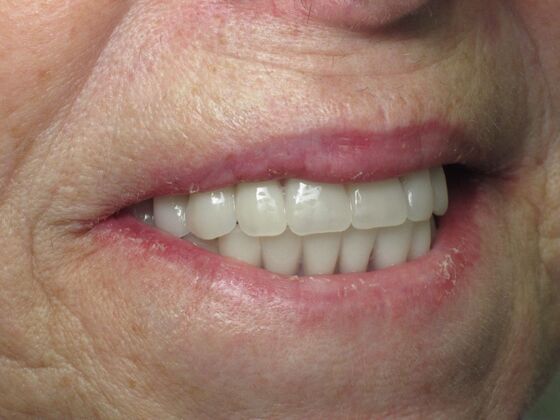 Teeth in a Day: Zest For Life Restored with Smile - After