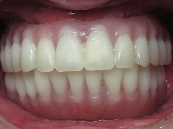 Teeth in a Day: Zest For Life Restored with Smile - Before