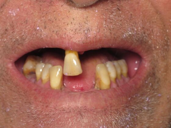 Teeth in a Day: He Joked About His Lone Wolf Tooth, So We Can Too - Before