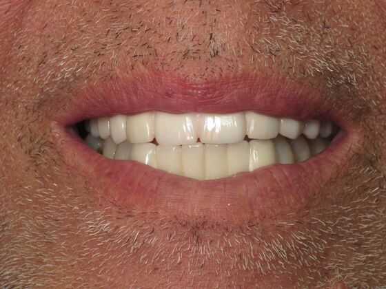 Teeth in a Day: He Joked About His Lone Wolf Tooth, So We Can Too - After