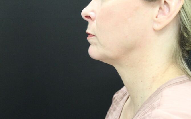 Liposuction Case 22 - Before