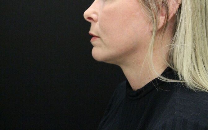 Liposuction Case 22 - After