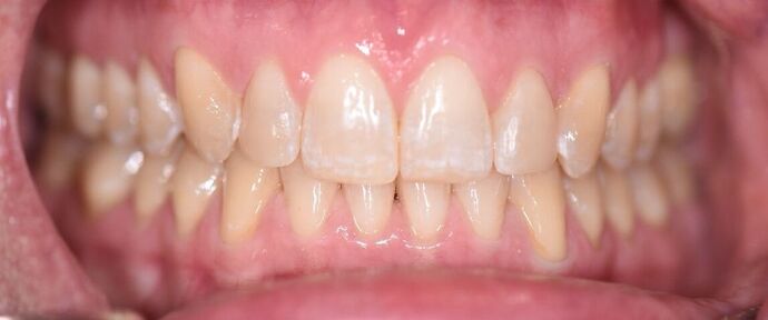 Invisalign Case 3 - Cuero, TX - After