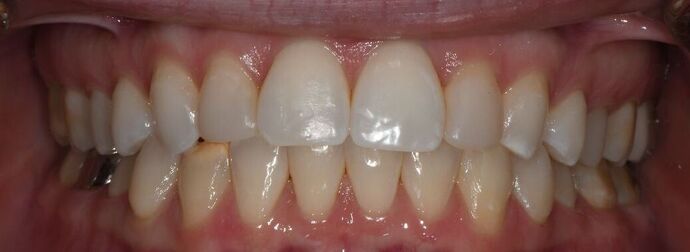 Invisalign Case 6 - Goliad, TX - After