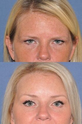 Endoscopic Browlift: Browlift, upper and lower eyelids at 4 months - Before and 4 months after