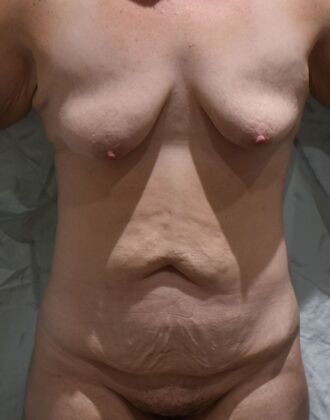 Massive Weight Loss : Case 108 - Before