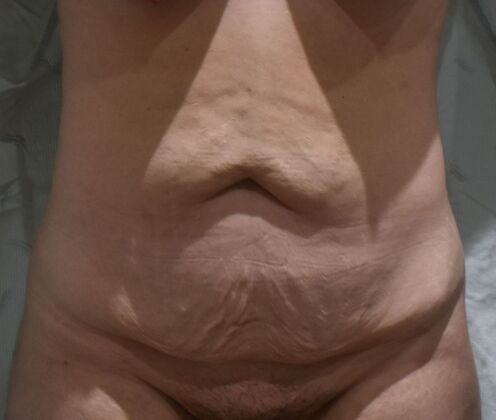 Tummy Tuck (Abdominoplasty): Case 375 - Before