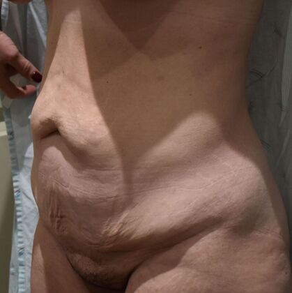 Tummy Tuck (Abdominoplasty): Case 375 - Before