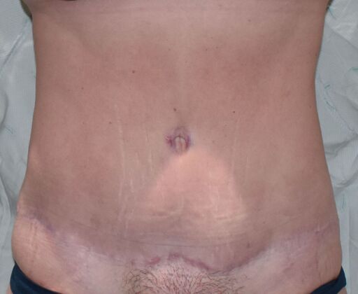 Tummy Tuck (Abdominoplasty): Case 375 - After