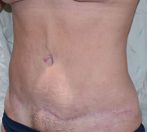 Tummy Tuck (Abdominoplasty): Case 375 - After