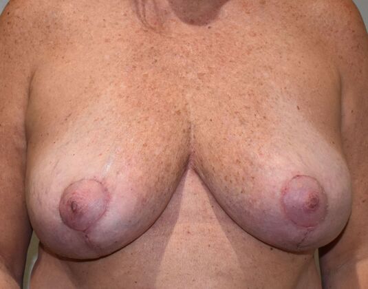 Breast Implant Removal: Case 20 - After