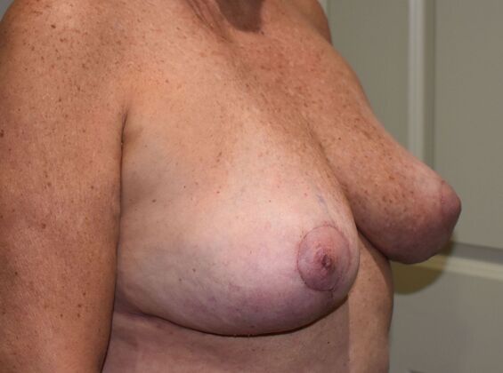 Breast Implant Removal: Case 20 - After