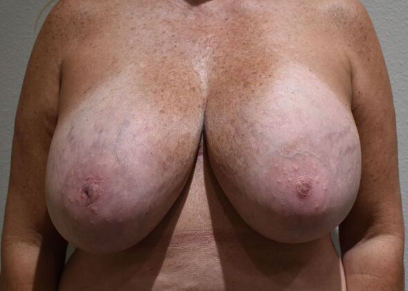 Breast Implant Removal: Case 20 - Before