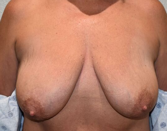 Breast Reconstruction Case 78 - Before