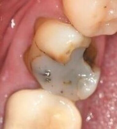 Crowns Case 26 - Victoria, TX - Before