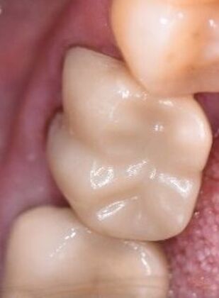 Crowns Case 26 - Victoria, TX - After