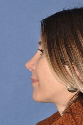Bulbous Hanging Tip Rhinoplasty Before And After Gallery