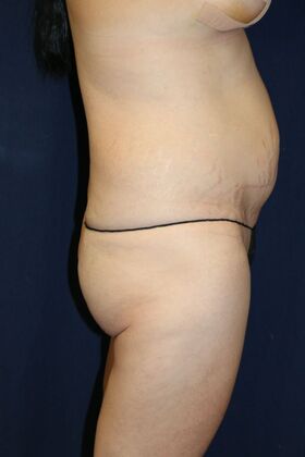 Brazilian Butt Lift : Case 17 - Before