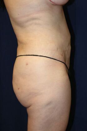 Brazilian Butt Lift : Case 17 - After