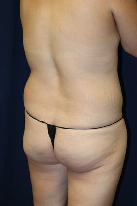 Brazilian Butt Lift : Case 17 - Before