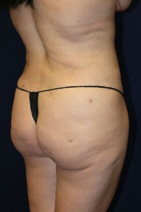 Brazilian Butt Lift : Case 17 - After