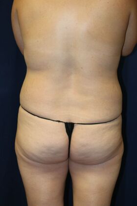 Brazilian Butt Lift : Case 17 - Before