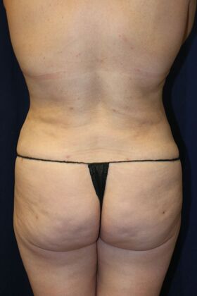 Brazilian Butt Lift : Case 17 - After