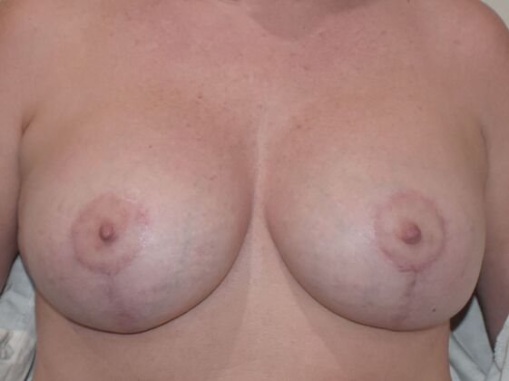 Breast Augmentation w/ Lift: Case 450 - After