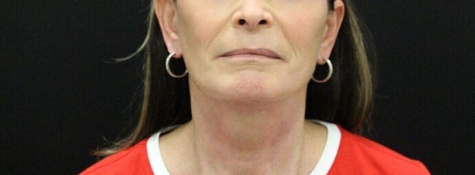 Face & Neck Lifts: Case 23 - After